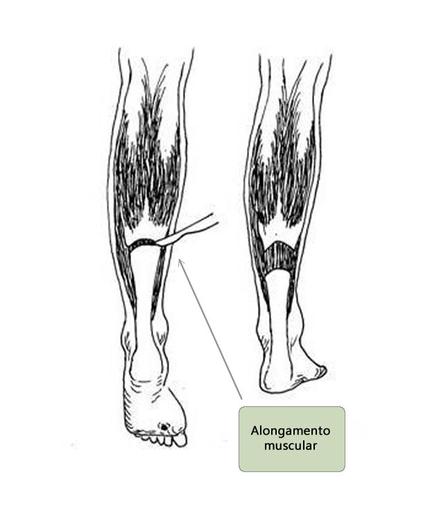 Alongamento muscular
