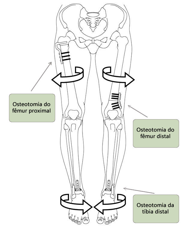 Osteotomia